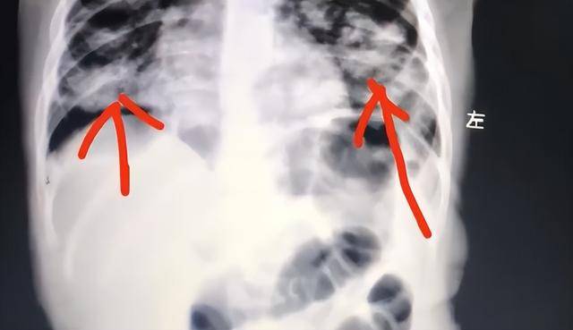 世界杯皇冠信用平台_1岁宝宝误食紫草油病危:宝妈错误手抠催吐 肺已全白